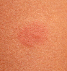 A wound on the skin of a person.