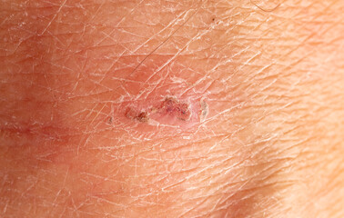 A wound on the skin of a person.