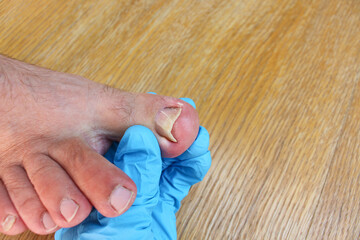 Ingrown toenail on foot. Doctor examines thumb.