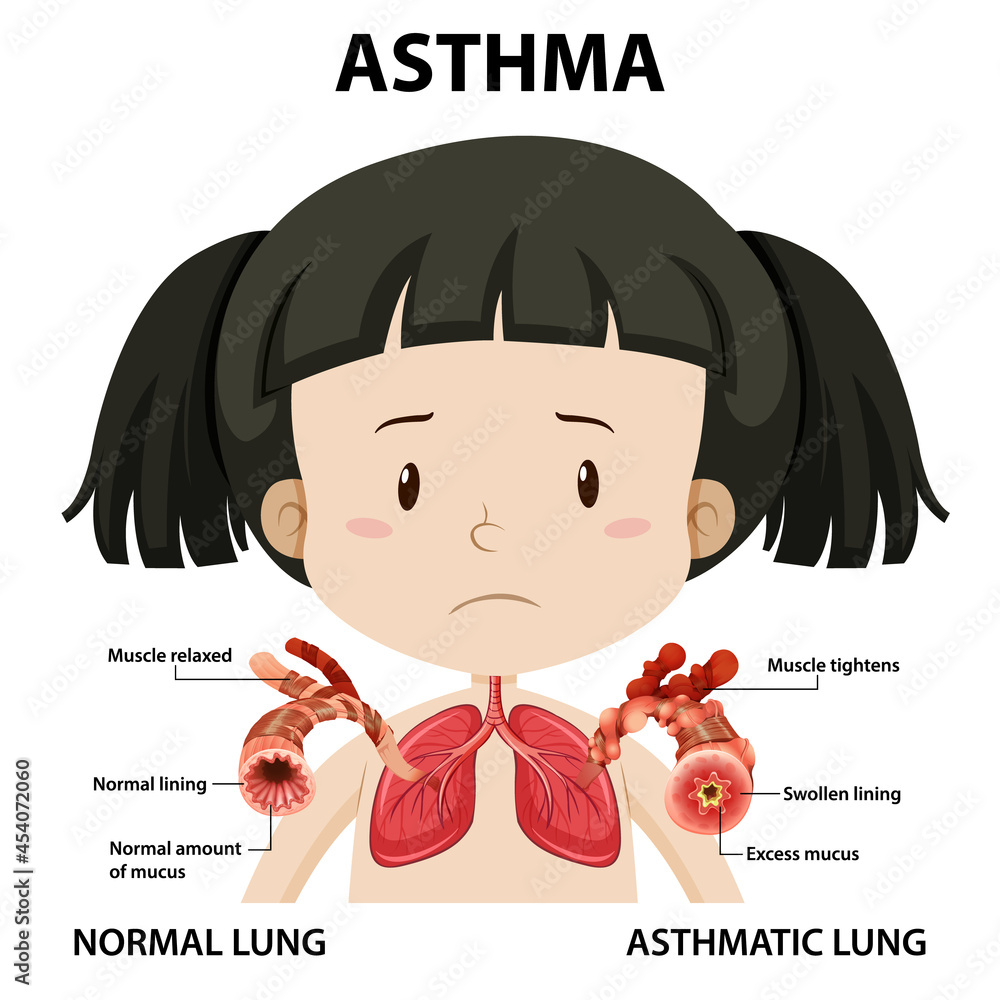 Poster Asthma diagram with normal lung and asthmatic lung