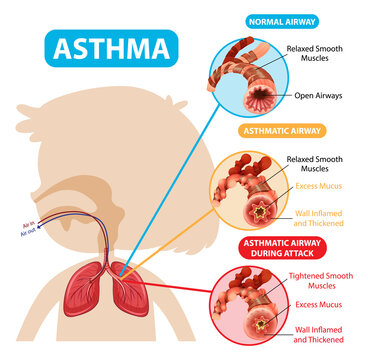 Asthma diagram with normal airway and asthmatic airway