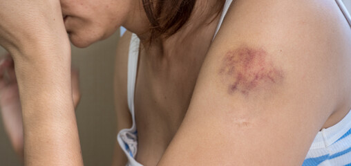A woman in a white-blue T-shirt with a bruise on her arm after the beatings touches the injury with her hand while sitting at the window close-up - obrazy, fototapety, plakaty