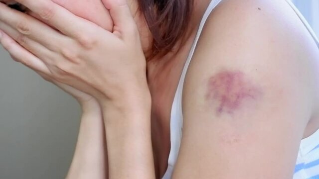 A woman in a white-blue T-shirt with a bruise on her arm after the beatings touches the injury with her hand while sitting at the window close-up