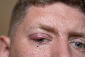 
the guy has an eye disease, inflammation of the eyelid