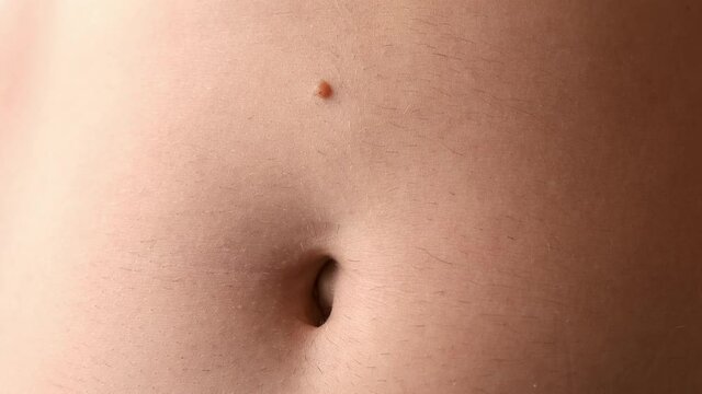 Large protruding mole wart on the man's stomach above the navel, closeup view. Human body with brown mole on tummy. Laser surgery, a one-day operation.