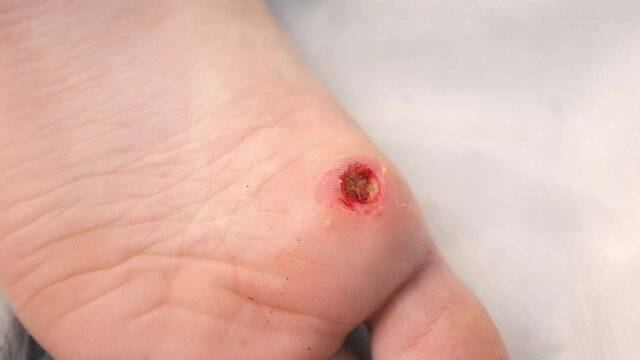 Wound of removed wart after laser removal on patient boy's foot, closeup view. One day surgery concept. Removed verruca papilloma on leg. One day surgery concept. Sore, wound after operation.