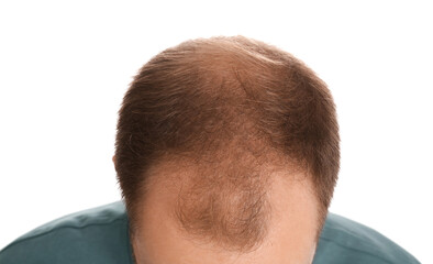Obraz premium Man with hair loss problem on white background, closeup. Trichology treatment
