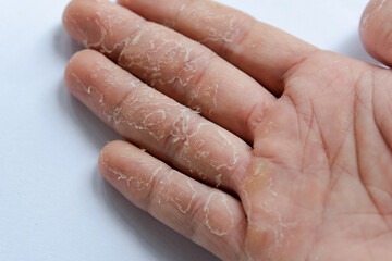 Peeling skin on hand and fingers. Desquamation