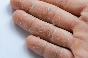 Peeling skin on hand and fingers. Desquamation