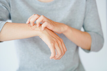 A woman scratching her arm, experiencing an allergic reaction or being stung by an insect. Skin disease concept.