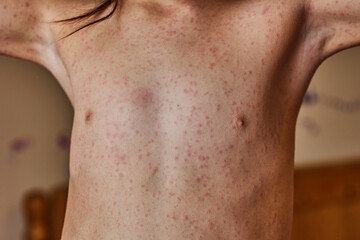 Naklejka premium allergic rash on the body of the patient. 5 year old girl. 