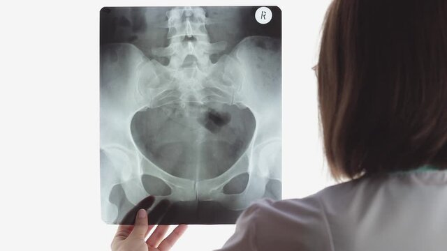 Female doctor with glasses holds and examines pelvic bones scan against background of light screen. Radiologist points to problem areas on X-ray. Gradual focusing.
