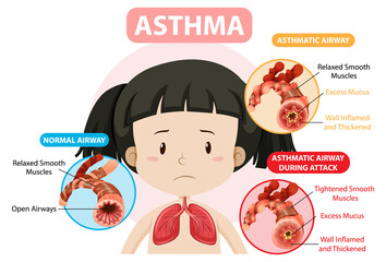 Asthma diagram with normal airway and asthmatic airway