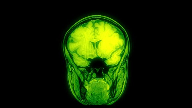 Computed medical tomography MRI upscaled scan of healthy young female head. Front view. Optically retimed for smooth motion. Green on black background.