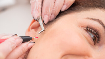 Woman on electro-epilation of the face. Hardware permanent removal of unwanted hair in the salon