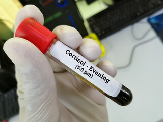 Scientist or Biochemist hold blood sample for Cortisol Evening (5.0 pm) test.