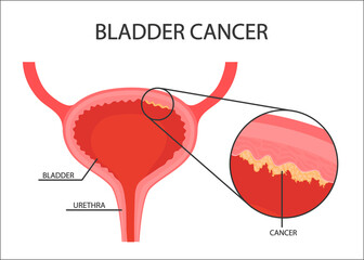 Human bladder cancer. malignant cells concept. Vector in cartoon style - obrazy, fototapety, plakaty