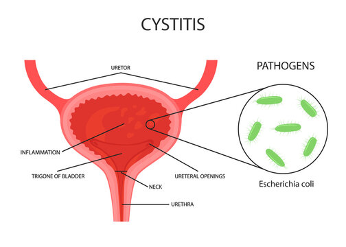 vector illustration of the bladder. cystitis