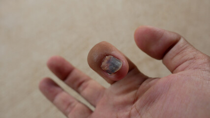 The accident left the fingers and nails torn and bruised, causing pain and requiring medical assistance.
