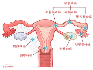 子宮外妊娠の子宮、卵巣、卵管、妊娠する場所のイラスト、illustration