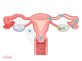 子宮外妊娠の子宮、卵巣、卵管、妊娠する場所のイラスト
