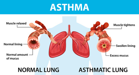 Asthma diagram with normal lung and asthmatic lung - obrazy, fototapety, plakaty