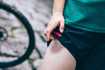 People with bruised leg casused by bike accident