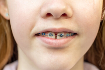 Close up of a teenage girl wearing metal braces. Orthodontic dental braces teeth straighteners. Gap...