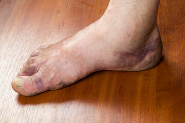 Swollen foot of a man's leg after a fracture. Purple bruise on human foot - obrazy, fototapety, plakaty