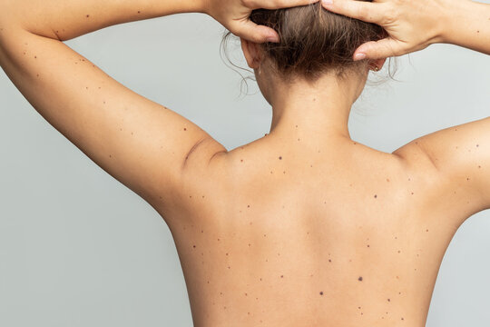 Close-up of a naked female back with a large number of moles on isolated on a gray background. The effect of sunlight on the skin
