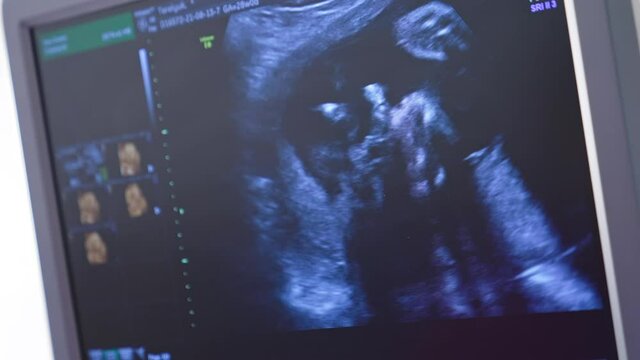 Baby in mother's womb is moving during sonography. Ultrasonography screen.