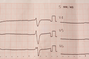Close view of electrocardiogram with heart rate readings