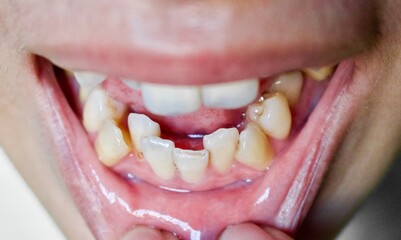 Stacked or overlapping teeth of Asian man. Also called crowded teeth.