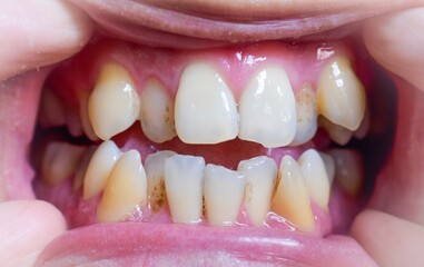 Stacked or overlapping teeth of Asian man. Also called crowded teeth.