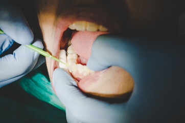 Dentist checking up teeth with ceramic brackets using dental tools