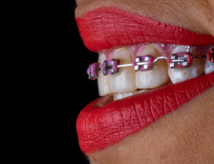 Closeup of a woman with red lipstick wearing braces against a black background