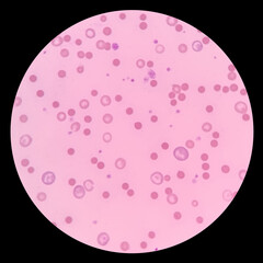 Polychromasia and spherocytosis seen in a peripheral blood smear from a patient with hereditary...