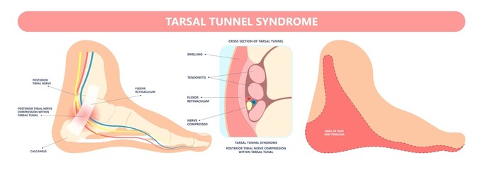 Tarsal tunnel syndrome flat feet flatfoot tibial tear running ankle bone tendon nerves pain foot compresses fallen arches vein cyst swollen spur carpal heel injury trauma torn inflamed adult - obrazy, fototapety, plakaty
