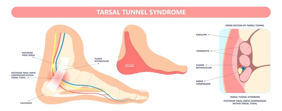 Tarsal Tunnel Syndrome Flat Feet Flatfoot Tibial Tear Running Ankle Bone Tendon Nerves Pain Foot Compresses Fallen Arches Vein Cyst Swollen Spur Carpal Heel Injury Trauma Torn Inflamed Adult