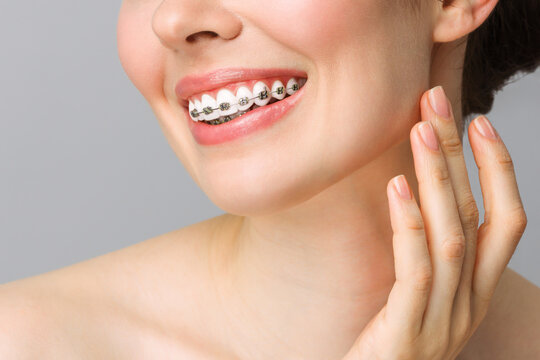 Orthodontic Dental Care Concept. Woman Healthy Smile close up. Closeup Ceramic and Metal Brackets on Teeth. Beautiful Female Smile with Braces.