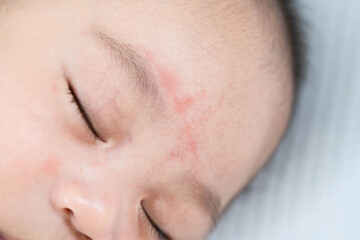 newborn sleeping. There is a mark on the forehead from accidental scratches.