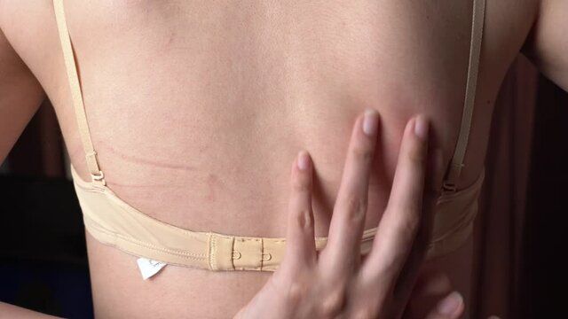 Traces of a bra on the back. An uncomfortable bra. Traces of clothing on the body. A woman's body. Irritation, itching, scabies and burning on the skin from clothing.Red skin