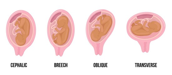 Obraz premium Latin arabian brown skin baby. Different wrong baby positions in uterus during pregnancy.