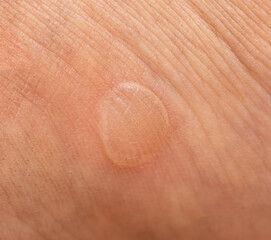 Fototapeta premium calluses on the skin of the feet as a background