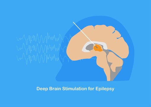 Deep Brain Stimulation Or DBS For Treatment Epilepsy Or Seizure