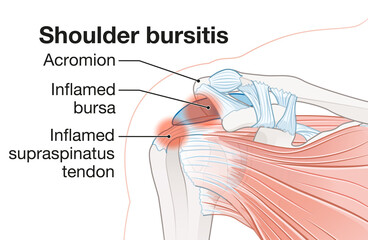 Shoulder bursitis. Inflamed bursa and supraspinatus tendon