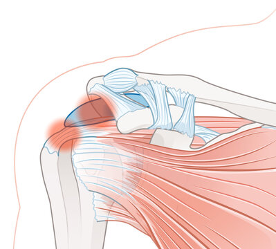 Shoulder anatomy. Bursitis and rotator cuff tendonitis. Vector illustration