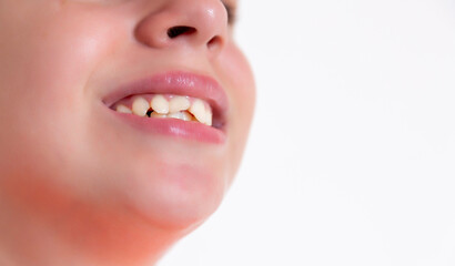 The girl knocked out two front teeth. Teeth augmentation.