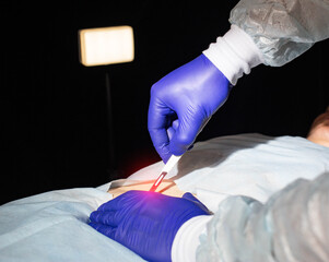 Doctor surgeon with a scalpel in his hand before bowel surgery in a patient, close-up. Small...