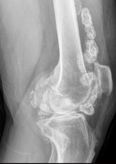 Synovial chondromatosis  lateral knee xray